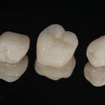 Capsula dente