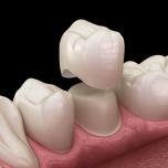 Come si mette una corona dentale