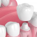 Composito dentale