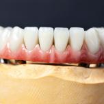 Corona dentale che si muove