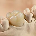 Corona dentale completa