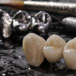Corona metallo ceramica