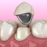 Costo medio di una corona dentale