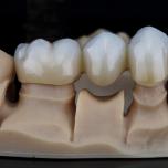 Denti in zirconio prima e dopo