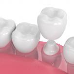 Denti incapsulati prima e dopo 