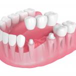 Denti incapsulati vip