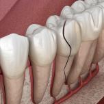 Frattura radice dente incapsulato sintomi