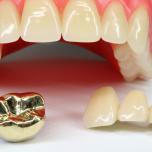 Incapsulare un dente fa male
