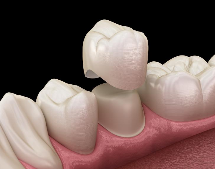 Come si mette una corona dentale Come si mette una corona dentale