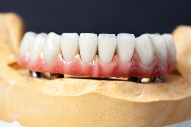 Corona dentale che si muove Corona dentale che si muove