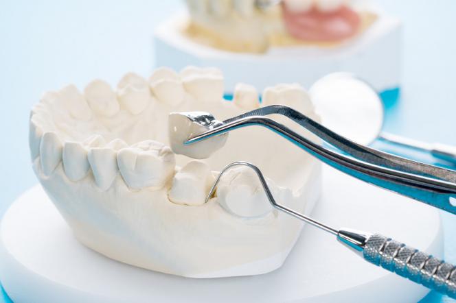 Corona impianto dentale Corona impianto dentale
