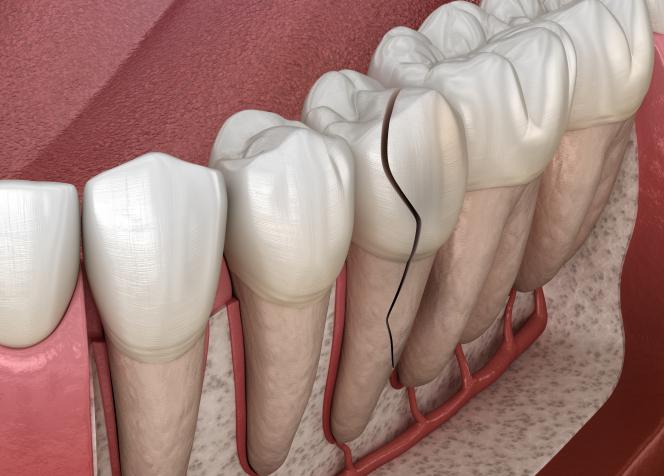 Frattura radice dente incapsulato sintomi Frattura radice dente incapsulato sintomi