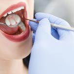 Agenesia dentale faccette
