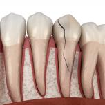 Dente spezzato alla radice