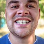 Dente spezzato cosa fare