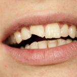 Dente spezzato
