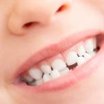 Denti piccoli