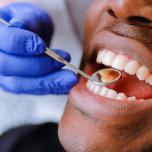 Faccette dentali come si applicano