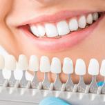 Faccette dentali