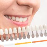 Faccette dentali prima e dopo