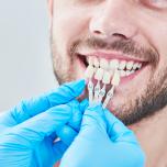 Faccette dentali senza limare il dente