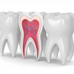 Radice dente rotta sintomi