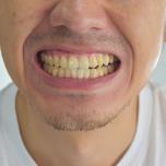 Ricostruzione smalto denti prezzo
