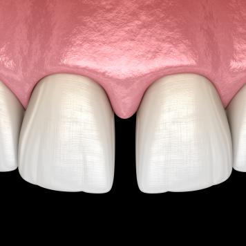 Faccette dentali diastema