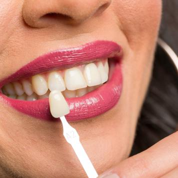 Le faccette dentali si possono rimuovere