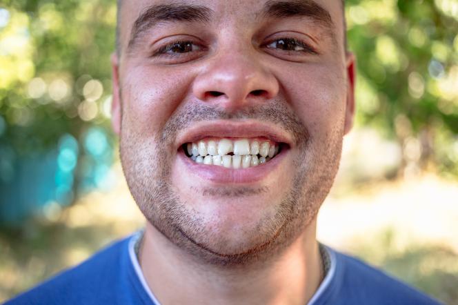 Dente spezzato cosa fare Dente spezzato cosa fare