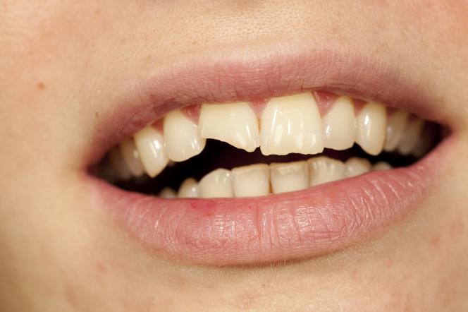 Dente spezzato Dente spezzato