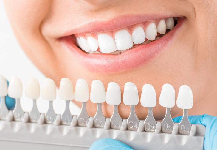 Faccette dentali Faccette dentali