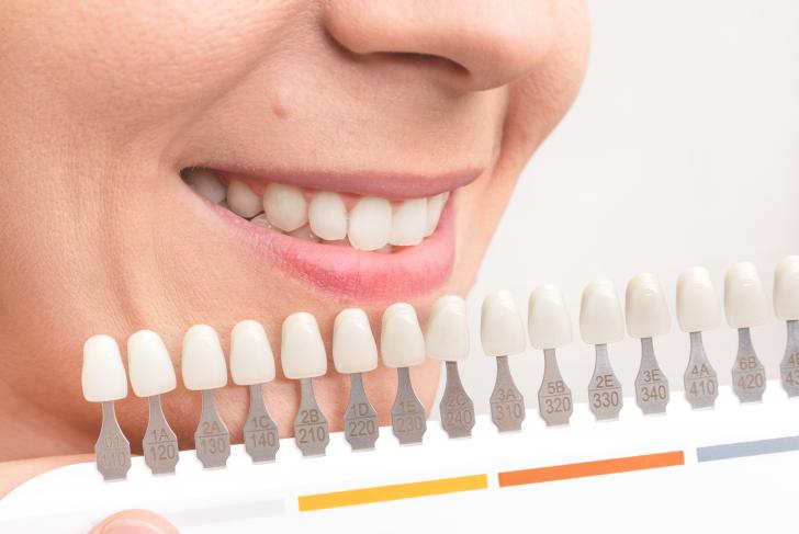 Faccette dentali prima e dopo Faccette dentali prima e dopo