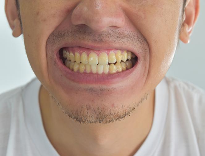 Ricostruzione smalto denti prezzo Ricostruzione smalto denti prezzo