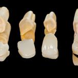 Come si prepara un intarsio dentale