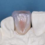 Intarsi dentali