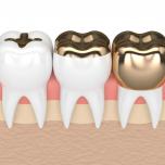 Intarsio dentale inlay onlay