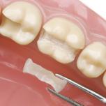 Intarsio dentale su dente devitalizzato