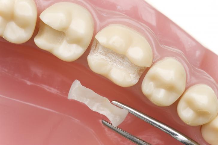 Intarsio dentale su dente devitalizzato Intarsio dentale su dente devitalizzato