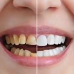 Sbiancamento dei denti