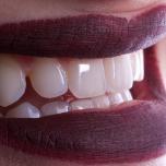 Sbiancamento denti opinioni