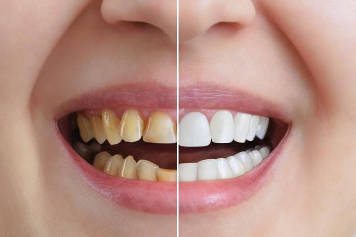 Sbiancamento dei denti Sbiancamento dei denti