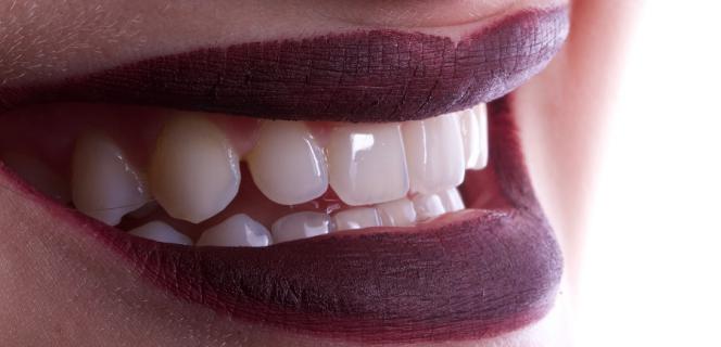 Sbiancamento denti opinioni Sbiancamento denti opinioni