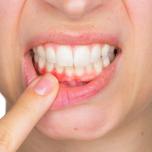 Colletti dentali scoperti