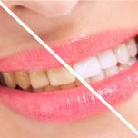Denti arancioni