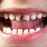 Denti brutti