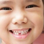 Denti macchiati bambini