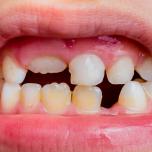 Denti permanenti macchiati nei bambini