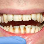 Denti rovinati