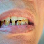 Erosione dentale da reflusso
